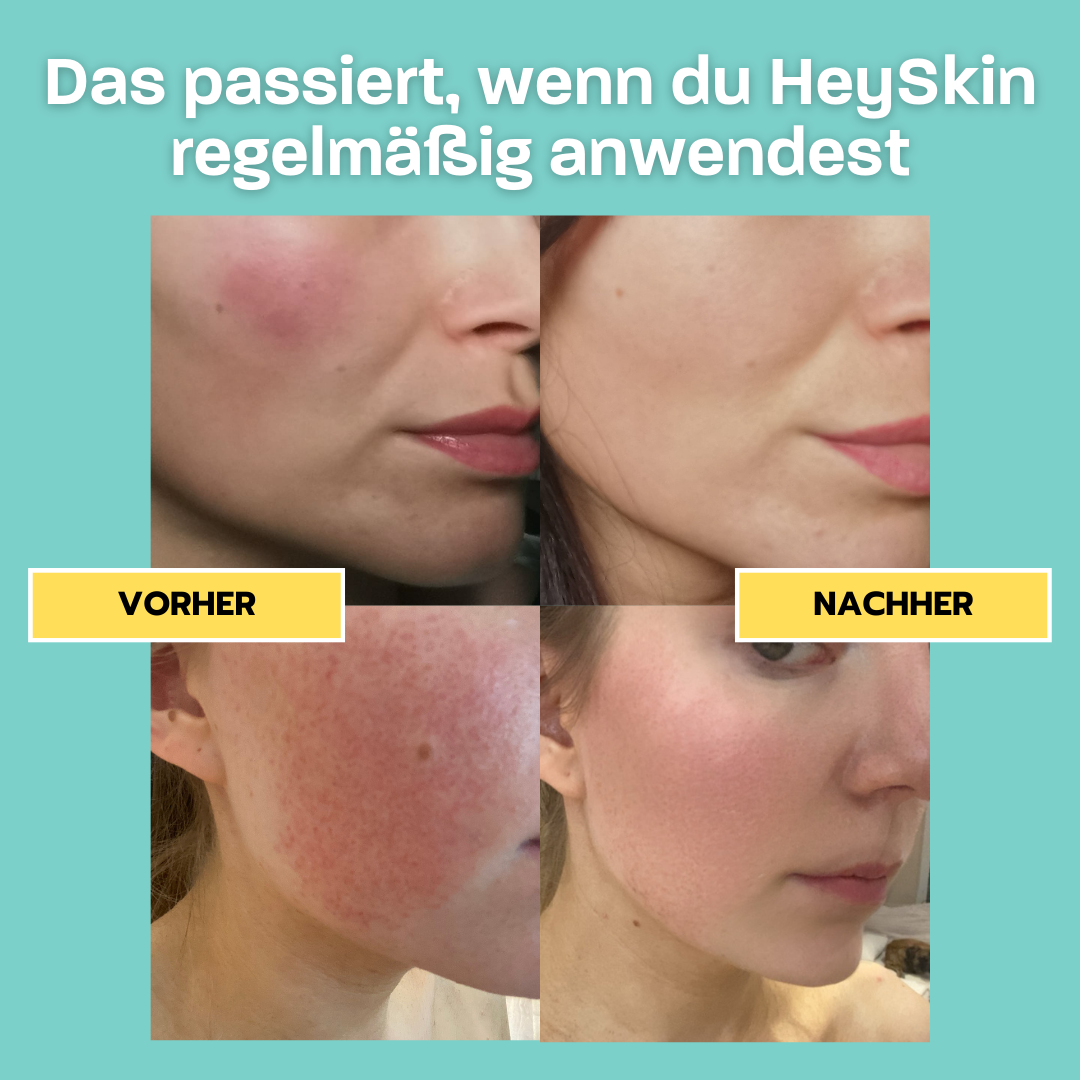 Das Rosacea Komplett-Set