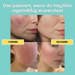 Das Rosacea Komplett-Set